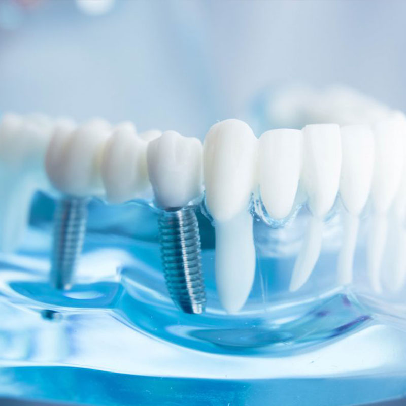 Dental Care at Ecospace, Dental Implants, Root canal treatment in Bellandur